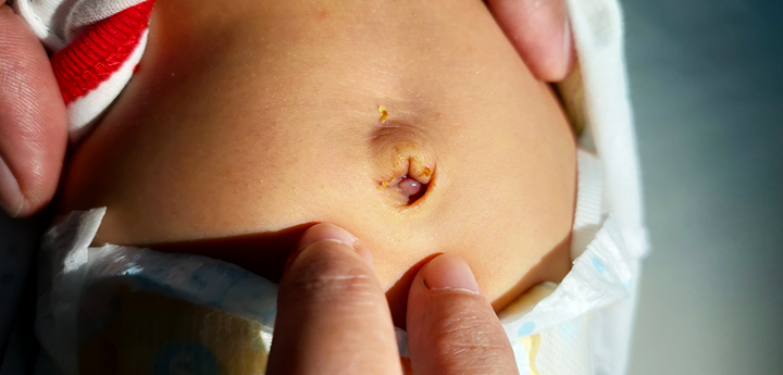 A baby's infected belly button with an adult's hand gently touching their stomach around the belly button.